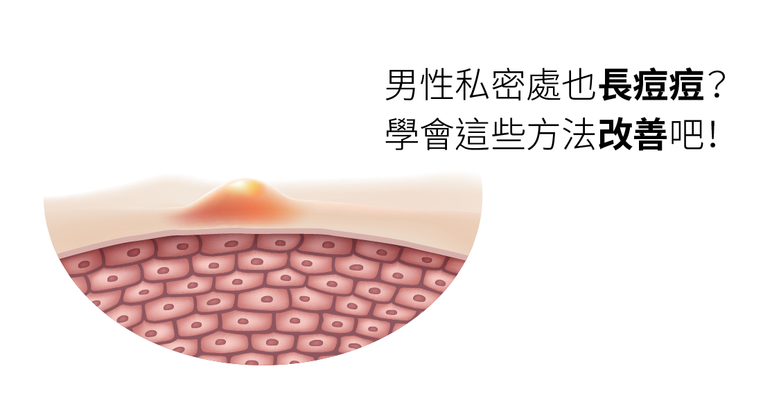 男性私密處也長痘痘？學會這些方法改善吧！