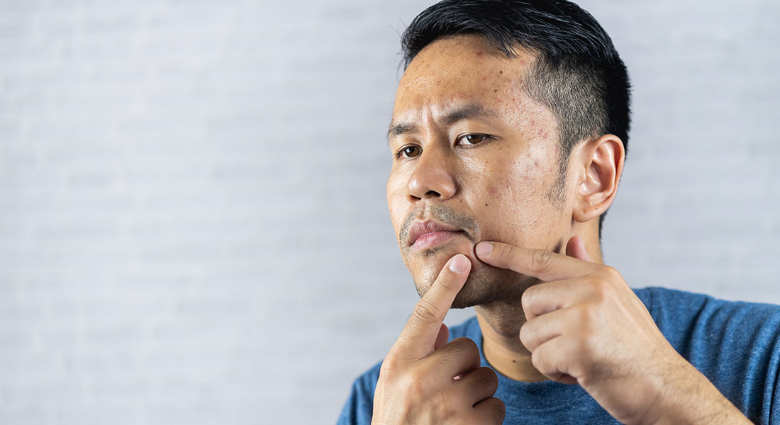 想要快速消除痘痘，可能嗎?