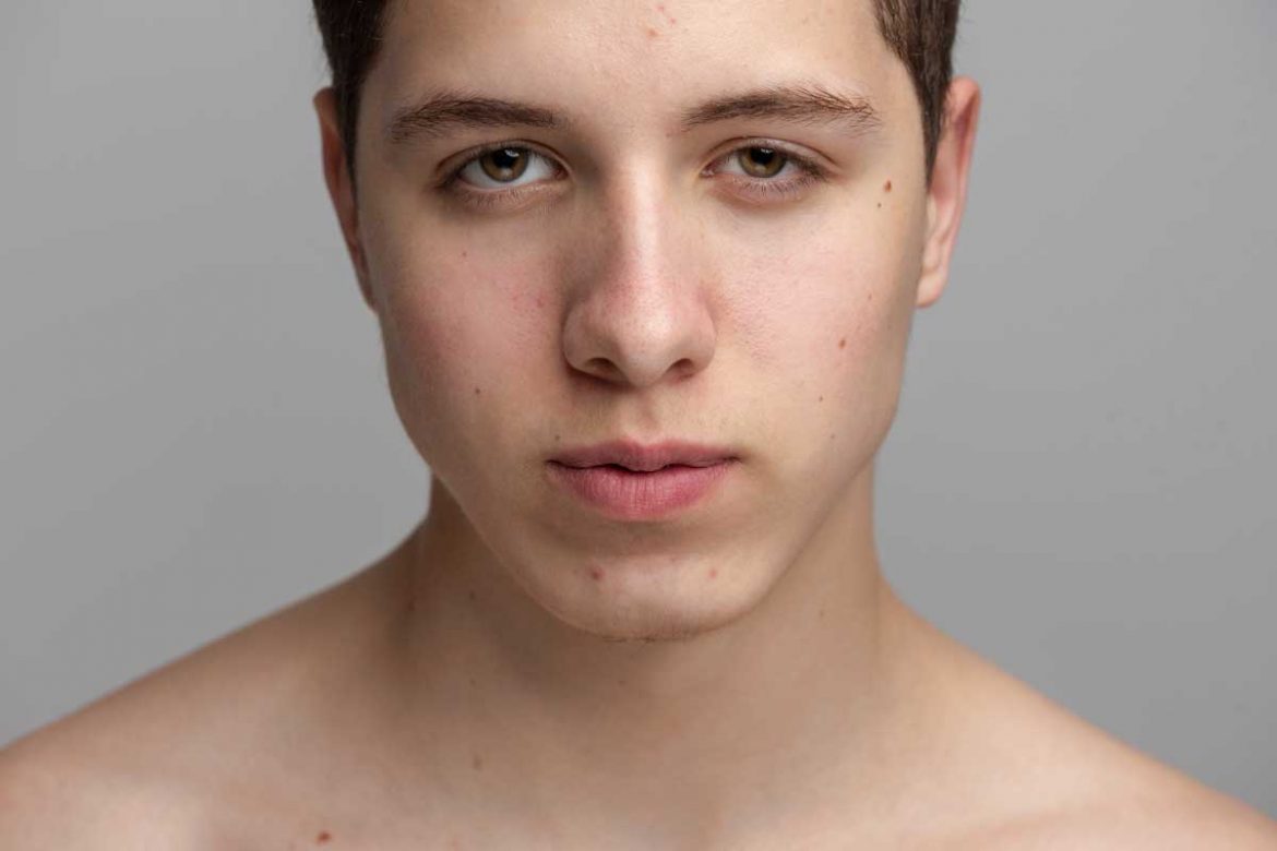 從根本解決！下巴長痘痘怎麼改善？8個有效方法帶走你的煩惱