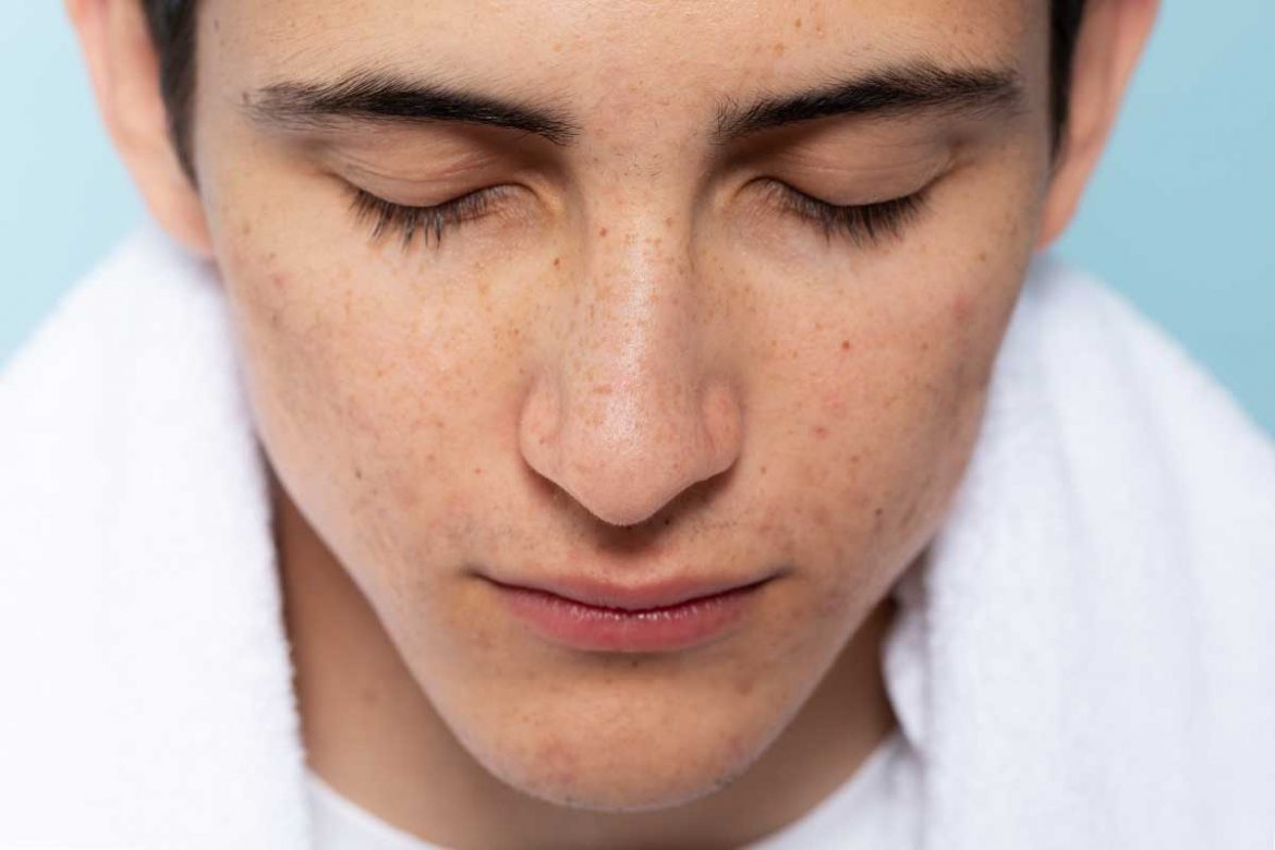 額頭長痘痘怎麼消？8個方法幫你迅速消除額頭痘痘！