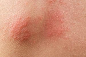 免疫系統失調紅疹的照片