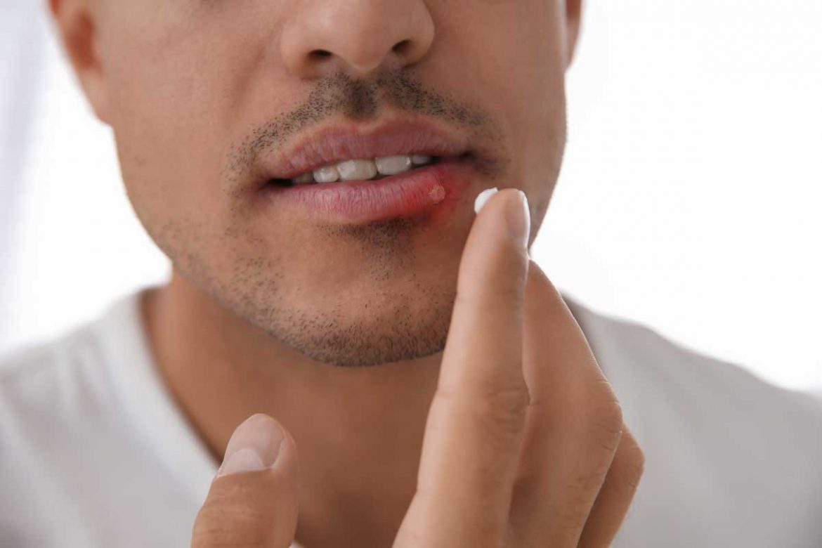 嘴角長痘痘的秘密揭密！探究原因及有效對策！