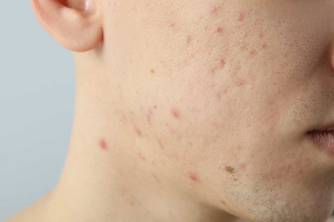 囊腫型痘痘：曼秀雷敦能解決紅腫大痘痘的煩惱嗎？