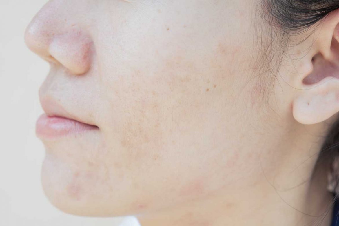 擺脫囊腫型青春痘的困擾：原因、處理及自然療法！