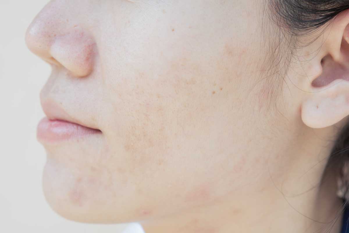 囊腫型青春痘的預防與注意事項