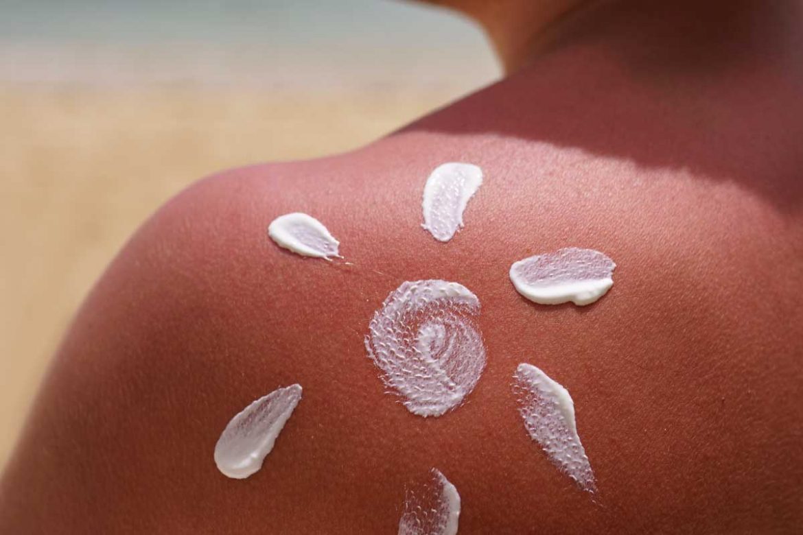 曬傷擦什麼藥膏？8款推薦產品助你輕鬆恢復肌膚健康！