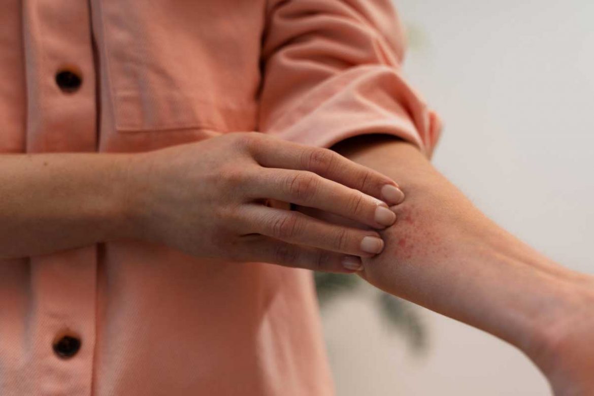 濕疹：能否自我痊癒？