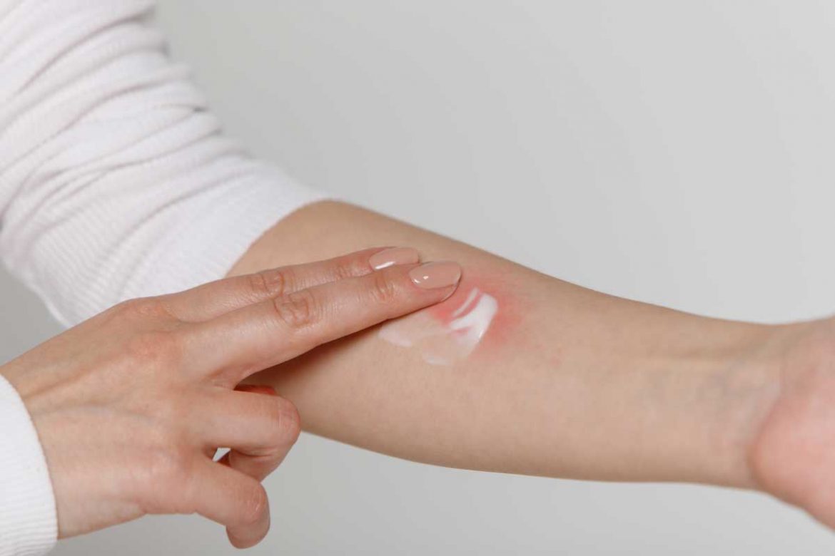 解放你的皮膚：異位性皮膚炎藥膏的神奇力量！