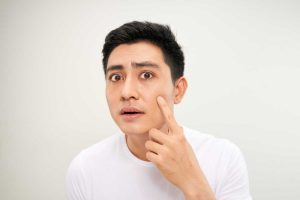 硬結型痘痘處理