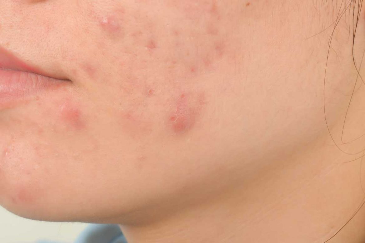 囊腫型痘痘：等它自己消失還是找方法解決？