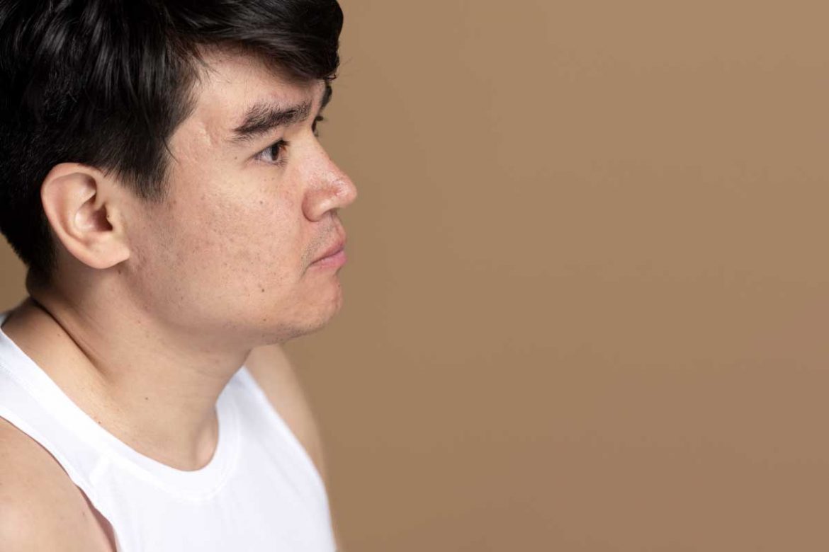 膿包痘痘怎麼處理：有效方法讓你擁有潔淨肌膚！