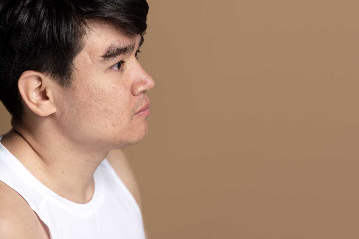 膿包痘痘怎麼處理