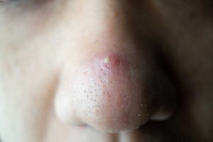 黑頭粉刺清除