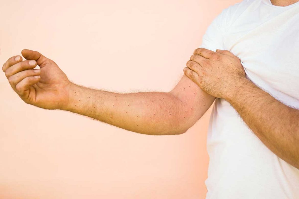 8種濕疹不能吃的水果，幫助濕疹快快好轉！